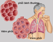 Viêm phổi là bệnh gì?