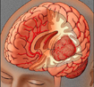 Dấu hiệu nhận biết bệnh u não