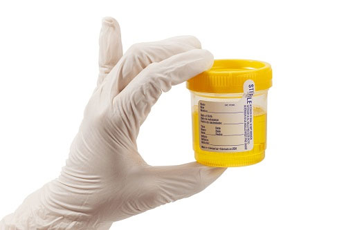 Cách đọc kết quả xét nghiệm nước tiểu