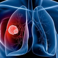 Những điều cần biết về bệnh ung thư di căn màng phổi