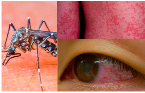 Làm trắc nghiệm để biết bạn có nguy cơ nhiễm vi rút Zika hay không