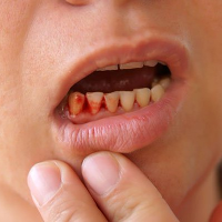 Cách chữa viêm lợi chảy máu chân răng cực hiệu nghiệm