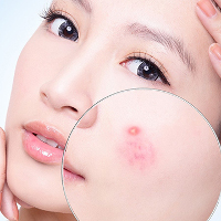 Cách làm mặt nạ hỗn hợp trị tận gốc mụn ẩn li ti trên mặt