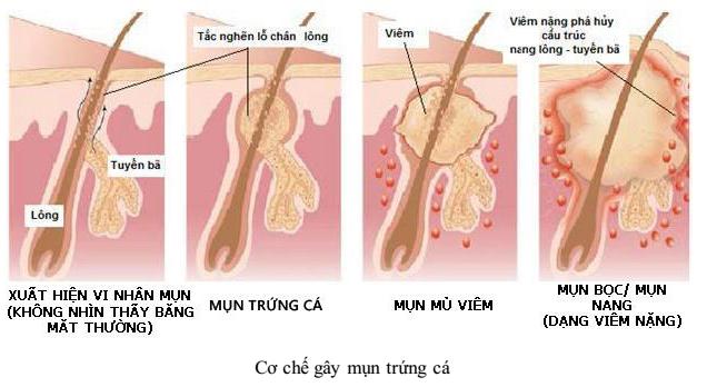 cơ chế gây mụn trứng cá Lý thuyết Sinh học lớp 8 bài 42: Vệ sinh da
