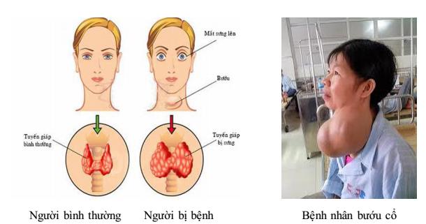 bệnh bướu cổ Lý thuyết Sinh học lớp 8 bài 56: Tuyến yên, tuyến giáp
