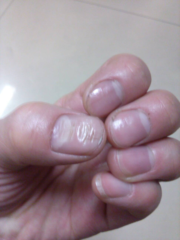 Nhìn móng tay đoán bệnh