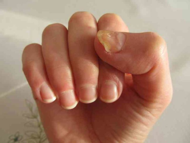 Nhìn móng tay đoán bệnh