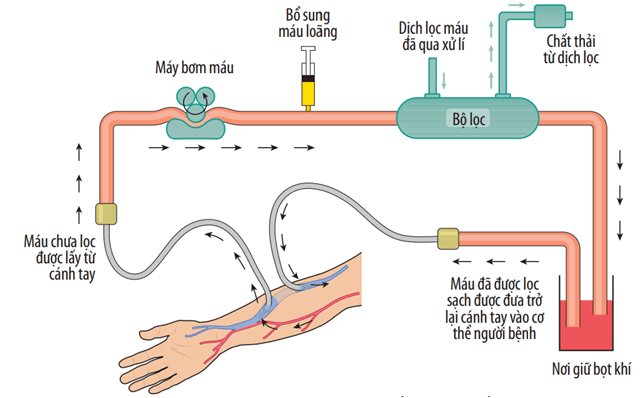 Sơ đồ lọc máu nhân tạo