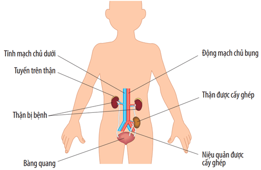 Sơ đồ vị trí ghép thận